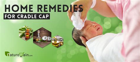 adult cradle cap home remedies.
